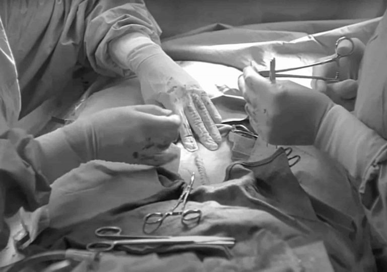 רשלנות רפואית בניתוח