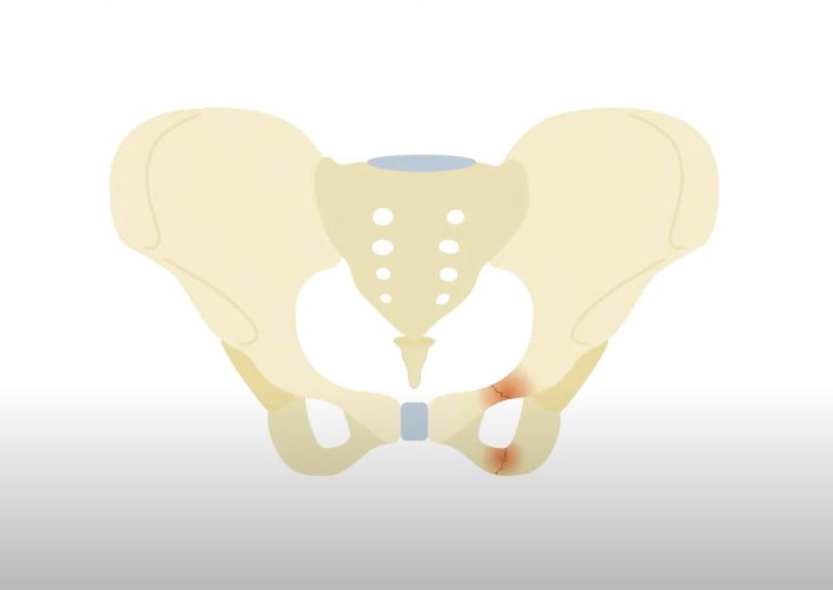 fracture ramus pobis