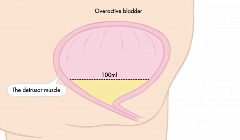 שלפוחית רשלנות