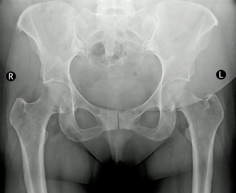 broken hip