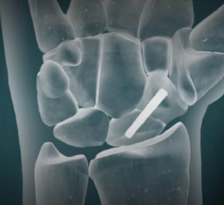 שבר בעצם הסירה