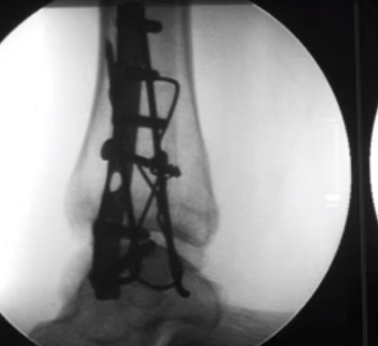 שבר בלי תזוזה