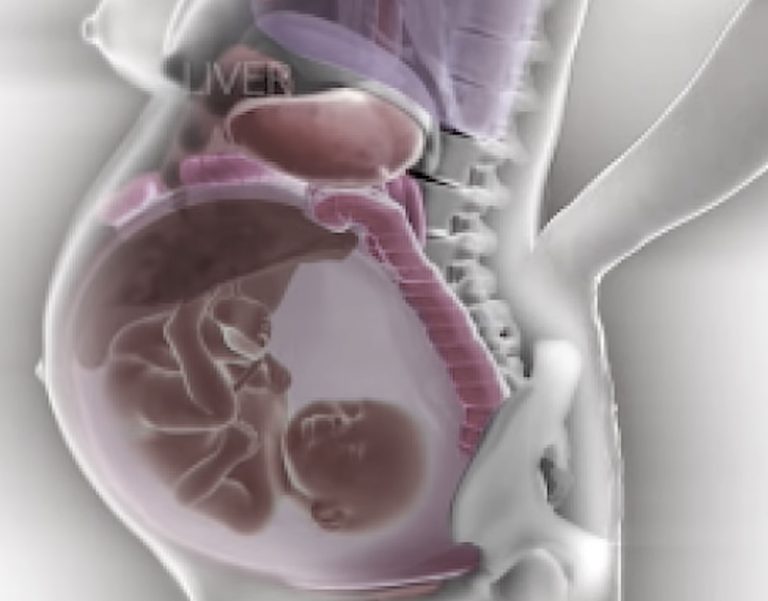 Amniotic fluid Embolism