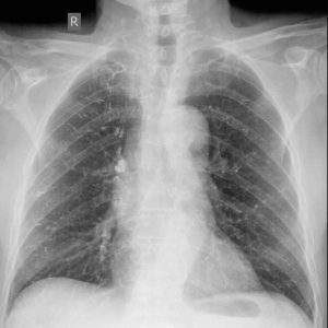 תסחיף ריאתי