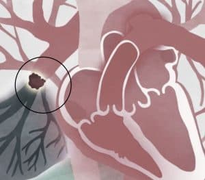 קריש דם ברגל שנסחף לריאה