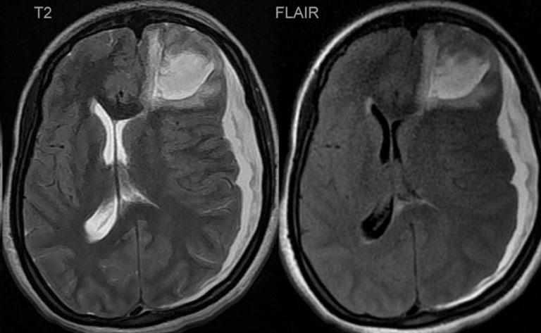 הצטברות של דם במח