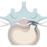 מיאלופתיה צווארית