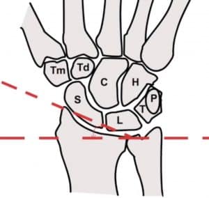 שבר רדיוס דיסטלי