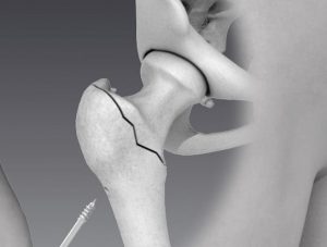 שבר במפרק ירך