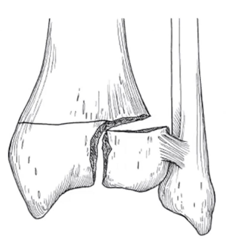 שבר בקרסול אחוזי נכות