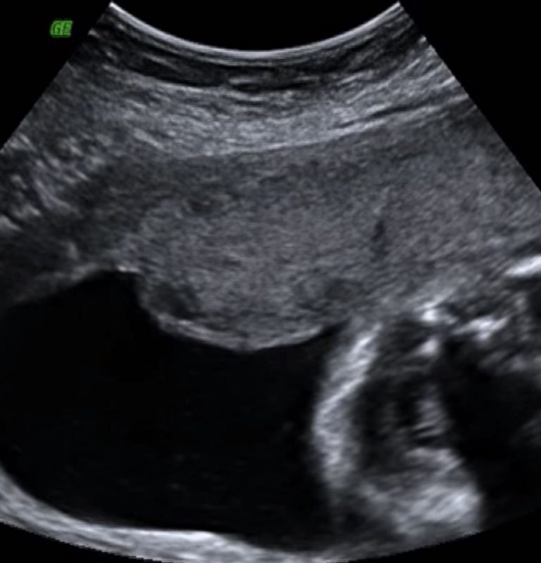 כוריואמניוניטיס