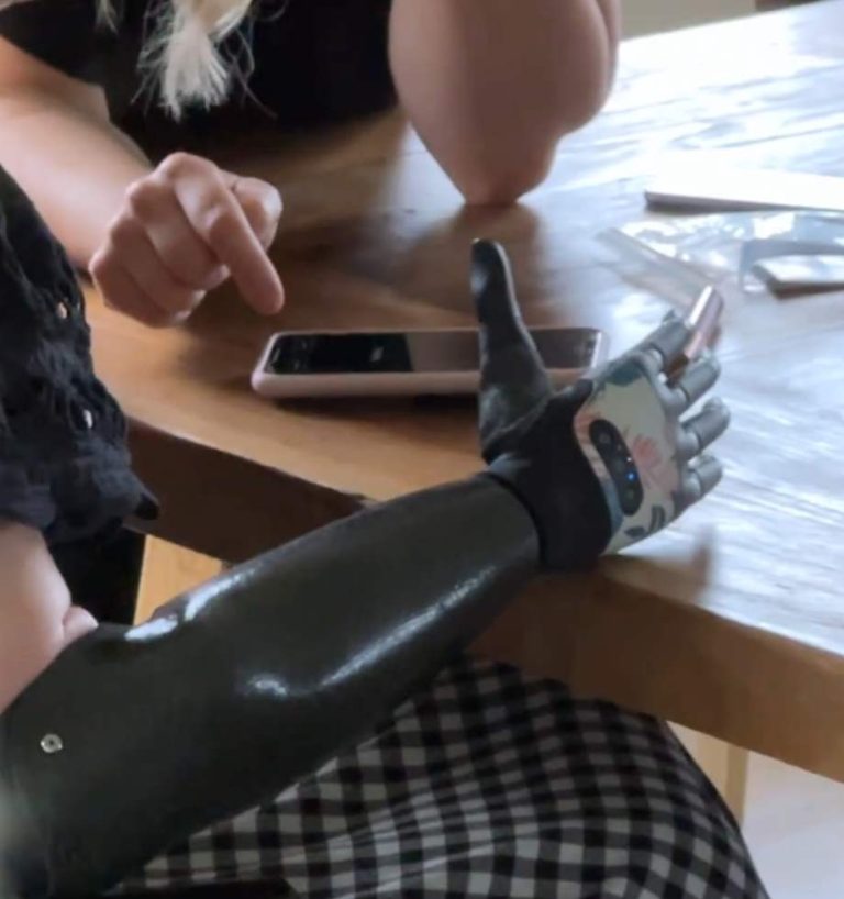 יד ביונית תותב תותבת ממוחשב