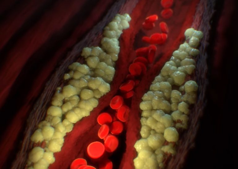 רשלנות רפואית מיאלומה