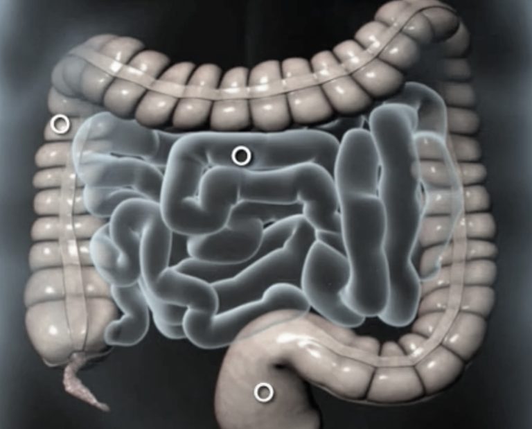אבחון מאוחר